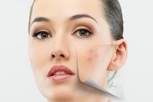 ACNE COPERTINA